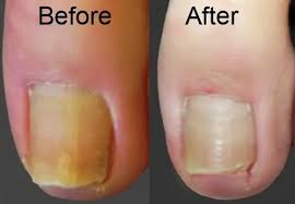 Before and After Result 4